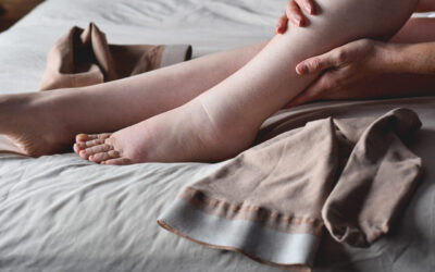 Woman putting on compression stockings on swollen feet affected by lymphedema condition